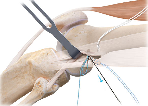 Arthrex - #2 FiberSnare suture, 26